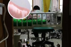 醋酸泼尼松片主要治疗什么病