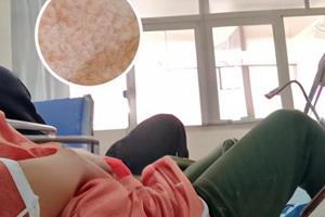 他克莫司能控制白斑扩散吗