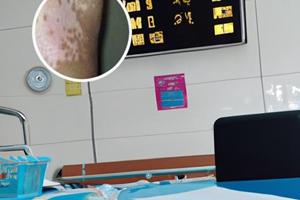 卤米松三氯生乳膏使用方法