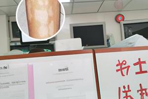 消白软膏治疗白斑多久能好