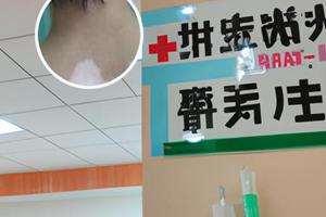 补骨脂可以擦脸上的白斑吗