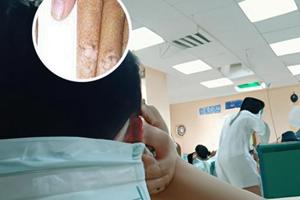 他克莫司能治疗黑斑吗