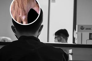 他克莫司治疗白斑