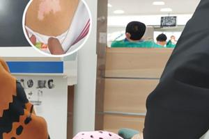 他克莫司软膏擦多长时间才见效果
