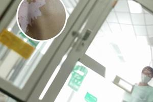 他克莫司软膏为什么能治黑色素