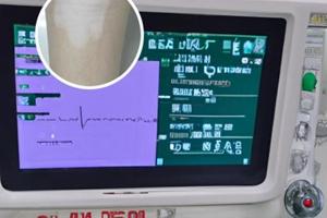 他克莫司软膏突然停用会怎么样