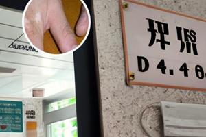手部涂卤米松治疗白斑有用吗