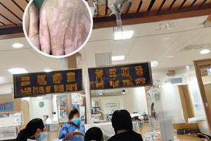 丁酸氢化可的松乳膏可以涂几天