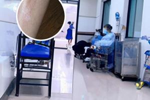他克莫司没有效果是什么原因