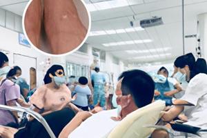 杨家方补骨脂白斑有用吗