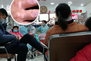他克莫司软膏用在什么部位
