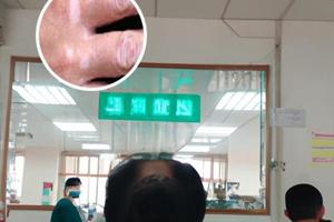 单纯涂他克莫司会治疗吗