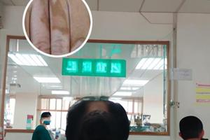 他克莫司多久一个疗程