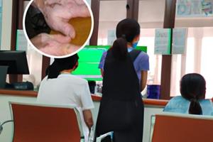 他克莫司软膏治疗色素减弱吗