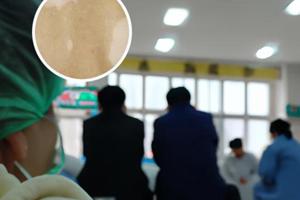 他克莫司用完以后痒痒正常吗