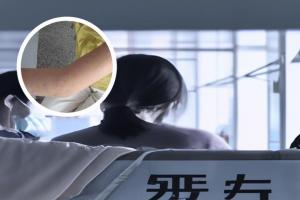 阿维a胶囊能治银屑病吗